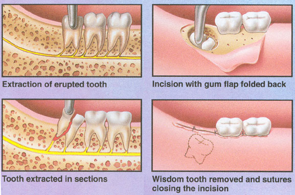 extraction/removal of wisdom teeth